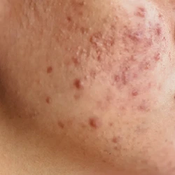 Hormonal acne in women on jawline