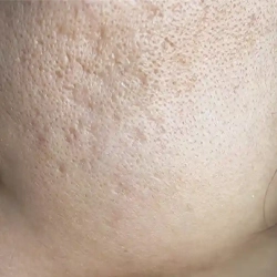 Ice pick acne scars