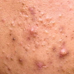Inflammatory acne showing papules and pustules