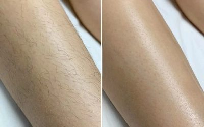Laser Hair removal treatment