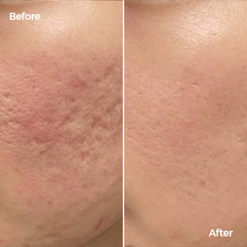 Rolling acne scars before and after treatment results