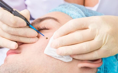 Mole and skin tag removal in Hyderabad