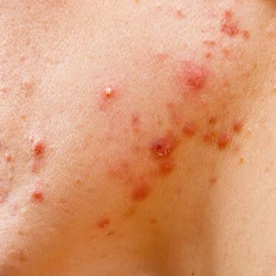 Nodular and cystic acne on facial skin