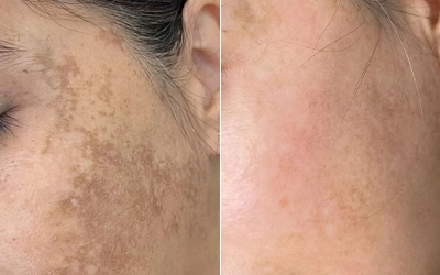 PIGMENTATION treatment