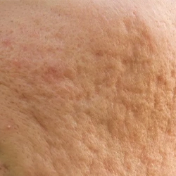 Pitted atrophic acne scars