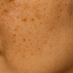 Post-inflammatory hyperpigmentation after acne