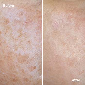 Q-switch laser treatment for post-acne PIH before and after