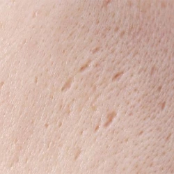Rolling acne scars