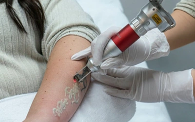 Fotona Pico laser tattoo removal Treatment