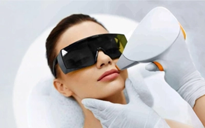 Upper lip laser hair removal