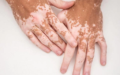 Vitiligo and pigmentation treatment