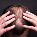 hair transplant Best Hair Transplant Clinic in Hyderabad